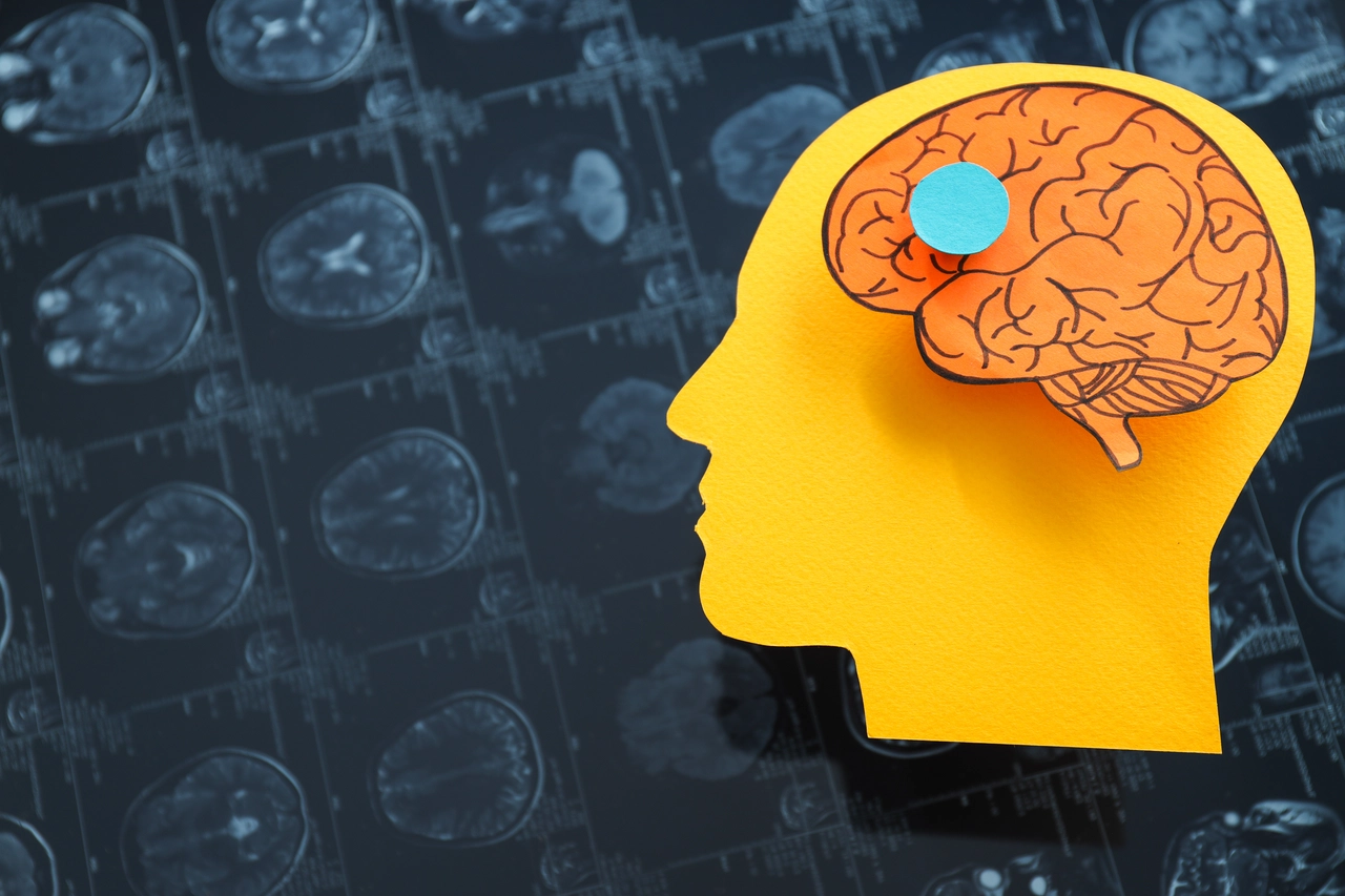 Alzheimer, una scoperta rivoluziona la comprensione della malattia Alzheimer, una scoperta rivoluziona la comprensione della malattia